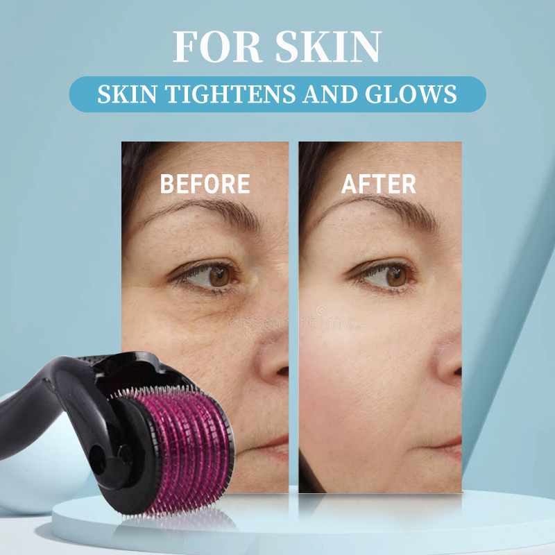 전문가용 540 롤러 더마 0.2/0.25/0.3mm  - Derma Roller 0.25 리뷰 및 가격