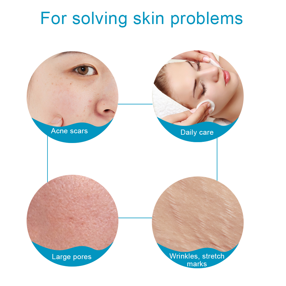 1pc 540 티타늄 더마 롤러 스킨 케어 수염 성장  - Derma Roller 0.25 리뷰 및 가격